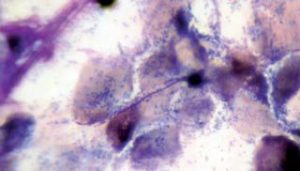 Figure 8. Bacterial overgrowth.