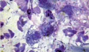 Figure 9. Degenerate neutrophils and intra and extra-cellular rods.