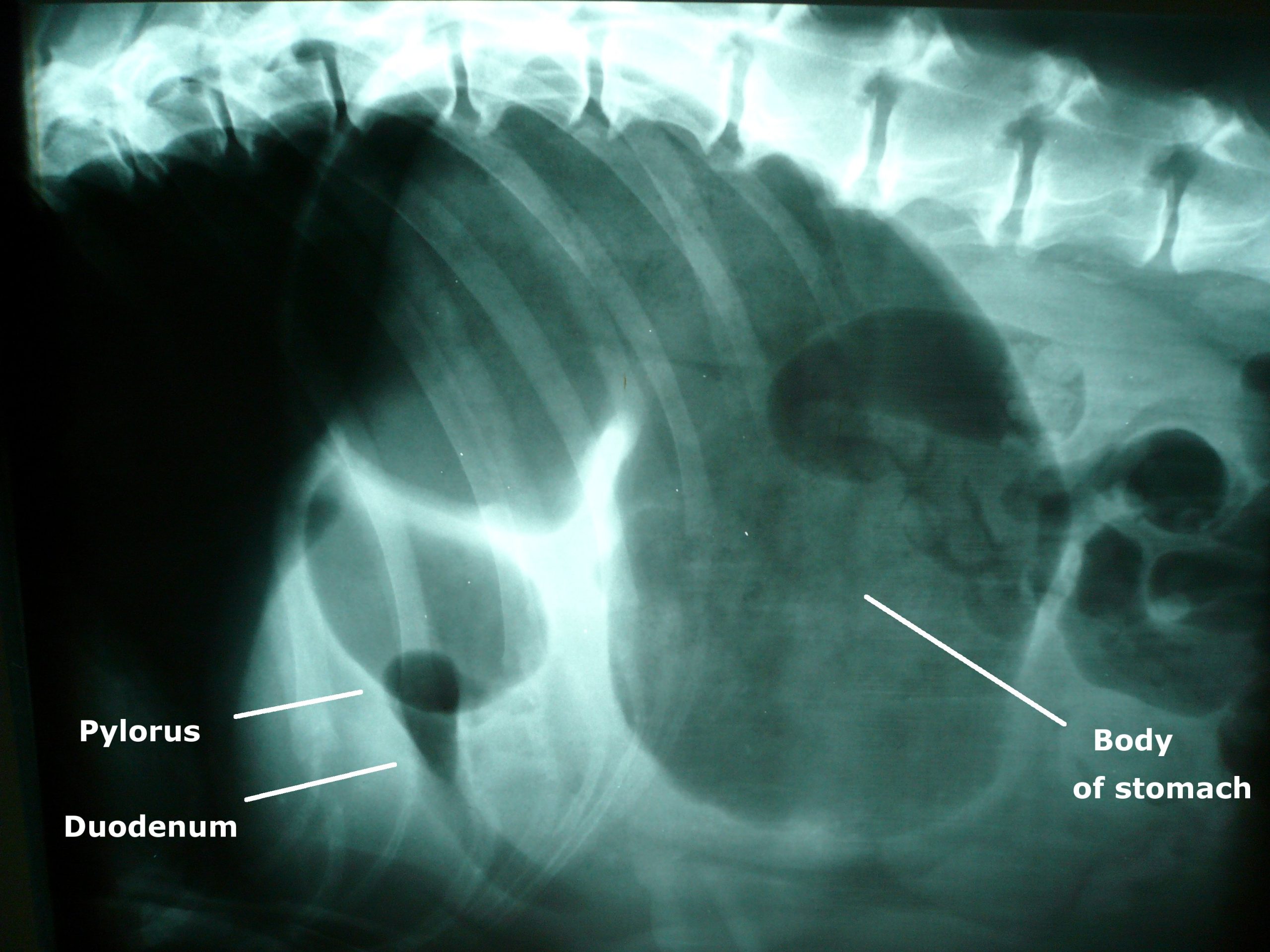 Presurgical treatment of acute gastric dilatation-volvulus