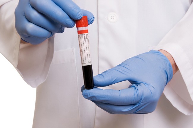 Ammonia tolerance test for diagnosis of portosystemic shunts