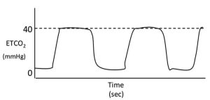 Figure 4. Rebreathing on a capnogram.