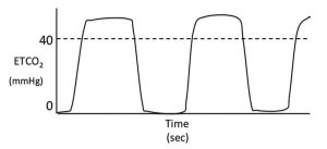Figure 6. Hypoventilation.