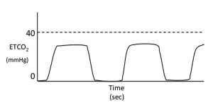 Figure 7. Hyperventilation.