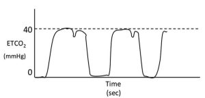 Figure 8. Spontaneous respiratory efforts during mechanical ventilation.