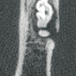 Figure 12b. Transverse image showing clear disruption to the lateral aspect of the mandible associated with the rostral root of the 311 tooth with associated root fracture, the true cause of the discharging sinus tract.