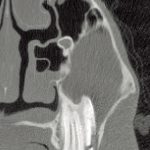 Slab fracture in a 210 tooth.