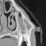 Midline sagittal fracture of a 209 tooth.