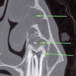 Apical infection in a 209 tooth.