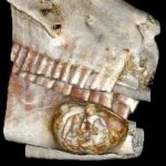 3D volume-rendered reconstruction.