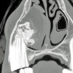 Figure 9. Odontoma over the rostral root of a 107 tooth in a seven-year-old pony with chronic nasal discharge. There is a lobulated area of enamel with a well-defined structure at the tooth root. After oral extraction of the 107 tooth, the odontoma was removed via a transnasal approach, as its size precluded extraction through the socket.