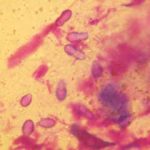 Figure 7. Cotton bud sample from a dog with Malassezia otitis with atopic dermatitis as the primary disease. Note the peanut or footprint-shaped yeast organisms. Some pigment granules are also present due to the coat colour of the dog (black Labrador retriever).