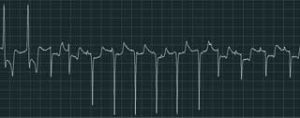 Figure 5a. An examples of an ECG recording from atypical myopathy cases: multiform ventricular tachycardia.