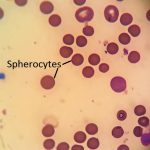 Figure 2. Blood smear with multiple spherocytes.