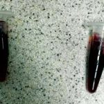 Figure 4. Pigmenturia to be tested by sedimentation.