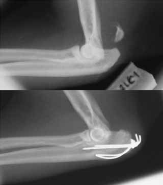 Physeal fractures in immature cats and dogs: part 1 – forelimbs