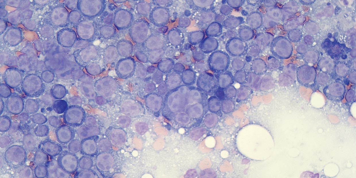 Figure 1a. Flow cytometry is most appropriate in aspirates where there is a prominent population of atypical cells, such as in aspirates labelled large cell lymphoma.
