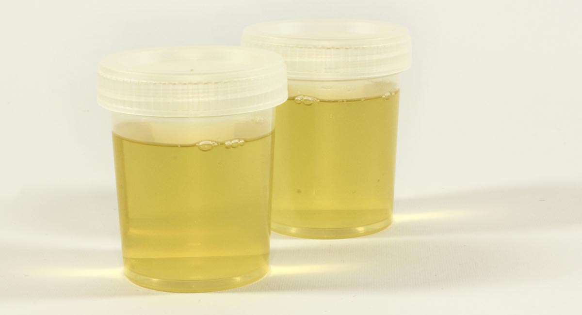 Urinalysis: the neglected test