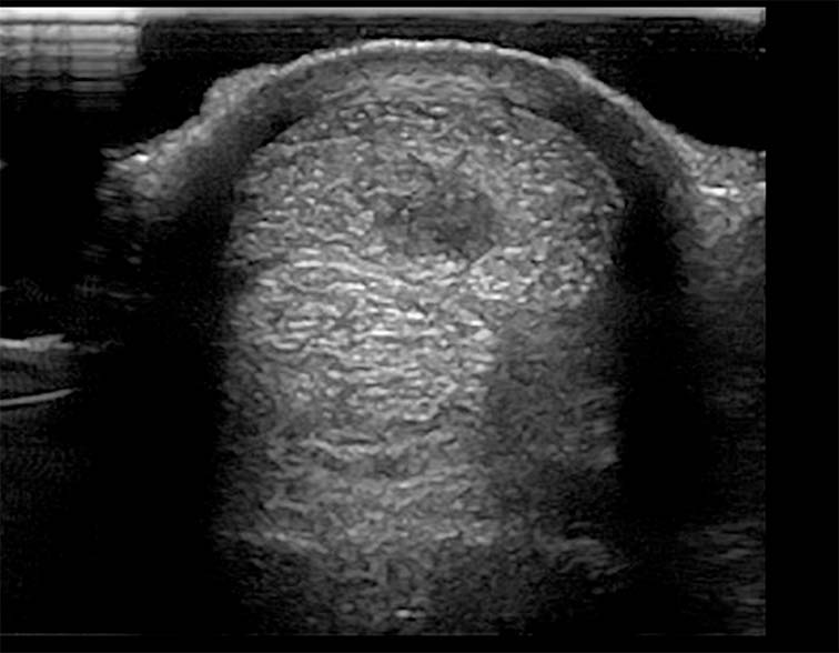 Figure 6. Transverse ultrasonographic image at the mid-metacarpal region with a large hypoechogenic core lesion within the superficial digital flexor tendon.