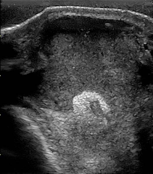 Figure 7. Transverse ultrasonographic image obtained over the medial suspensory ligament branch. Note the large heterogeneous soft tissue swelling (abscess) and hypoechogenic lesion within the suspensory ligament branch following a penetrating injury.
