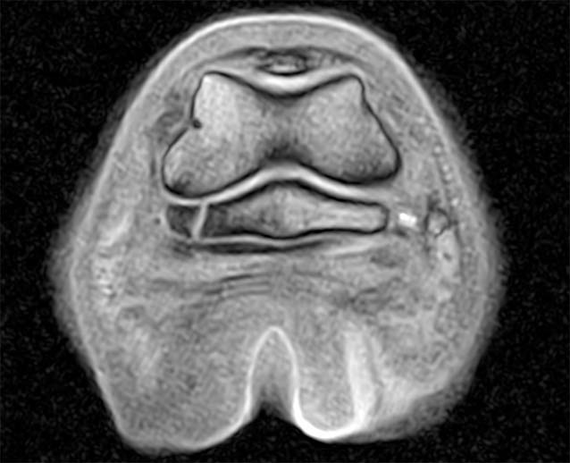 Figure 8. A T1-weighted MRI image of the equine foot at the level of the navicular bone. Note the linear hyperintense fracture plane within the navicular bone. This modality allows for detailed assessment of the adjacent deep digital flexor tendon.