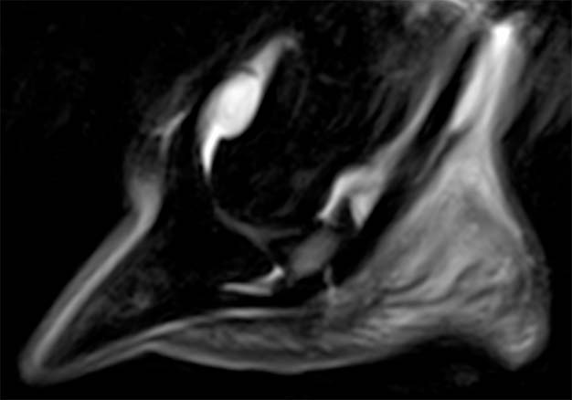 Figure 9. Sagittal short tau inversion recovery MRI image of the equine foot following solar penetration of a nail. There is a hyperintense tract extending from the sole to the navicular bone and markedly increased signal intensity within the navicular bone, indicating presence of fluid-based material. Presence of fluid within bone cannot be assessed on radiographs.