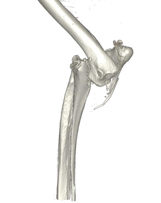 Lateral CT scan of the right elbow.