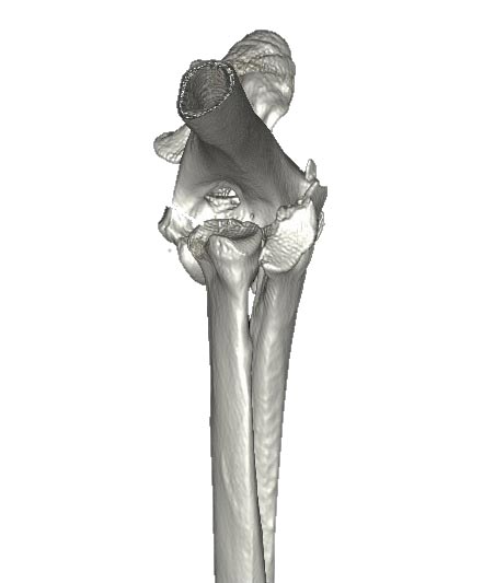 Craniocaudal CT scan of the right elbow.