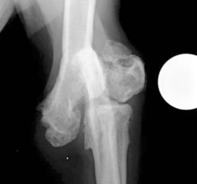 Orthogonal radiograph of the left elbow, showing a chronic lateral humeral condylar fracture malunion.