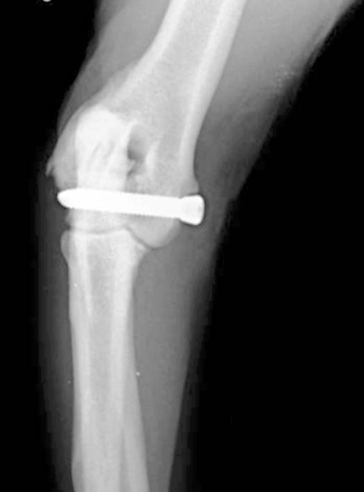 Figure 3. Postoperative craniocaudal radiograph of the right elbow showing the 5mm transcondylar screw.