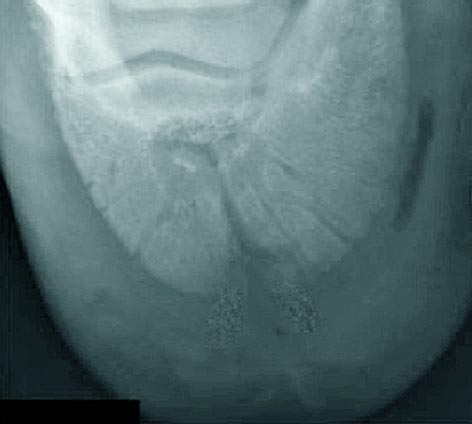 Figure 10. Vascular channel widening at the solar margin.