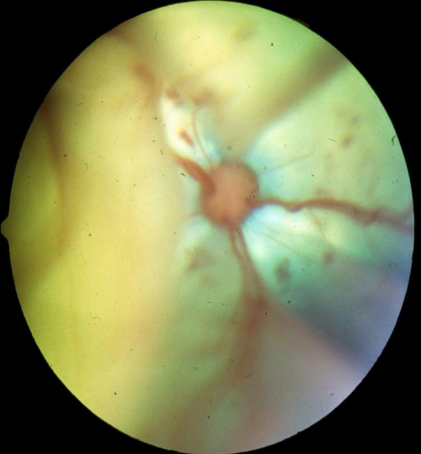 Figures 2b. Ocular target organ damage in cats with hypertension. Cats often present with sudden blindness and widely dilated pupils when complete retinal detachment has occurred in both eyes. This could be avoided if the early signs of hypertensive retinopathy were spotted before complete detachment occurred. Early signs of hypertensive retinopathy include grey areas of protein insudation from blood vessels, variable calibre of these vessels and small haemorrhages. Areas of overtly detached retina radiate from the optic nerve, while the rest of the fundus has a reduced tapetal reflectivity as retinal oedema causes flat retinal detachment across the rest of the fundus, causing blindness. Image: David Williams