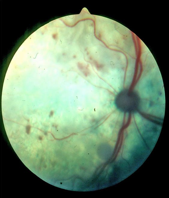 Figures 2c. Ocular target organ damage in cats with hypertension. Cats often present with sudden blindness and widely dilated pupils when complete retinal detachment has occurred in both eyes. This could be avoided if the early signs of hypertensive retinopathy were spotted before complete detachment occurred. Early signs of hypertensive retinopathy include grey areas of protein insudation from blood vessels, variable calibre of these vessels and small haemorrhages. Areas of overtly detached retina radiate from the optic nerve, while the rest of the fundus has a reduced tapetal reflectivity as retinal oedema causes flat retinal detachment across the rest of the fundus, causing blindness. Image: David Williams