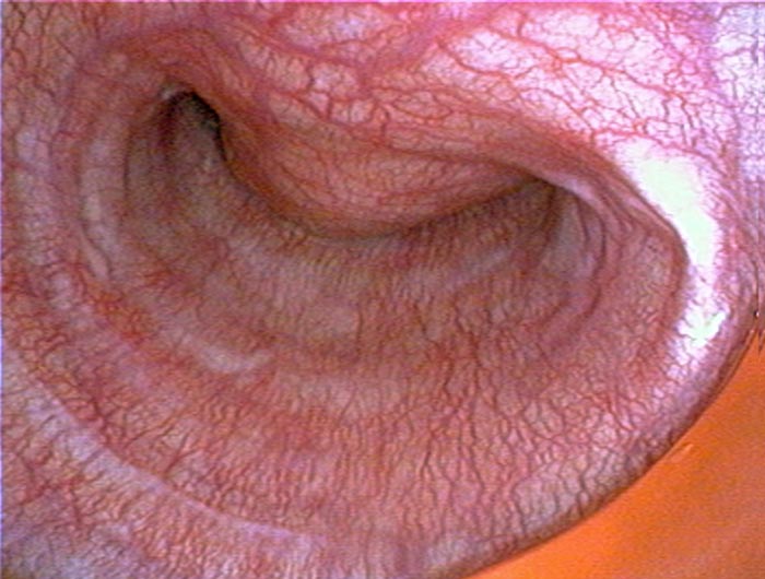 Figure 3. A tracheoscopic image of the obstructive distal cervical tracheal mass.