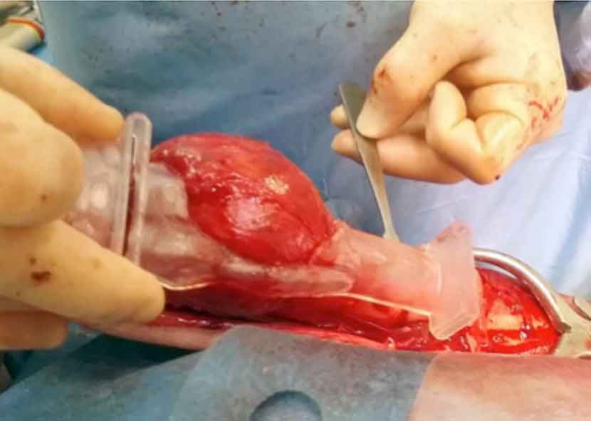 Cutting guide used to resect the tumour. Image: Neil Burton and Jonathan Deacon.