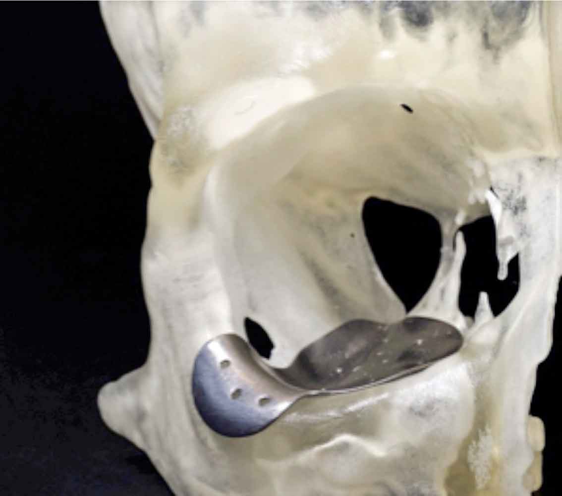 Orbital floor implant. Image: CBM Medical.