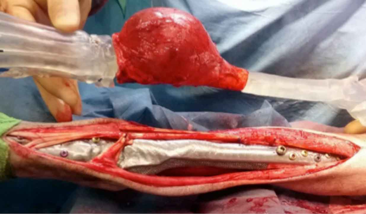 Mandibular implant used to replace tumour defects. Image: CBM Medical.