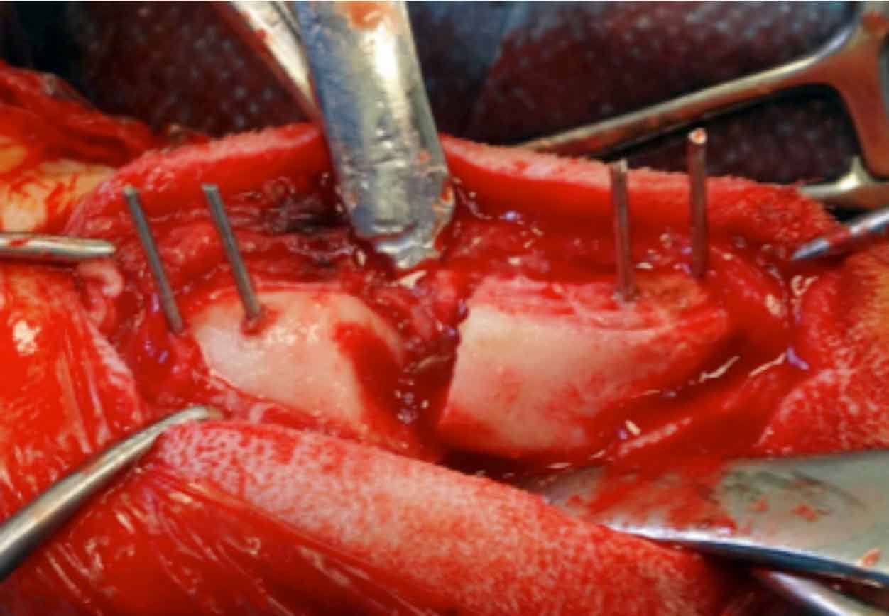 Cutting guide use in surgery with K-wires. Image: CBM Medical.