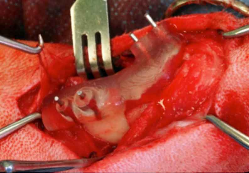 Repositioning guide used to manipulate the bone to its repositioned location. The implant contours around the repositioning guide until the screws are placed in the holes. Image: CBM Medical.