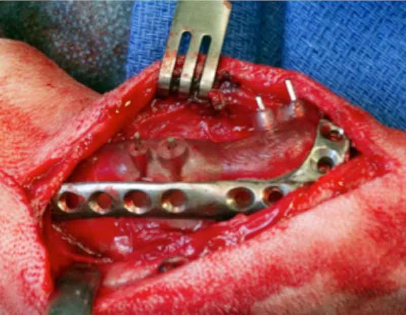 Repositioning guide used to manipulate the bone to its repositioned location. The implant contours around the repositioning guide until the screws are placed in the holes. Image: CBM Medical.