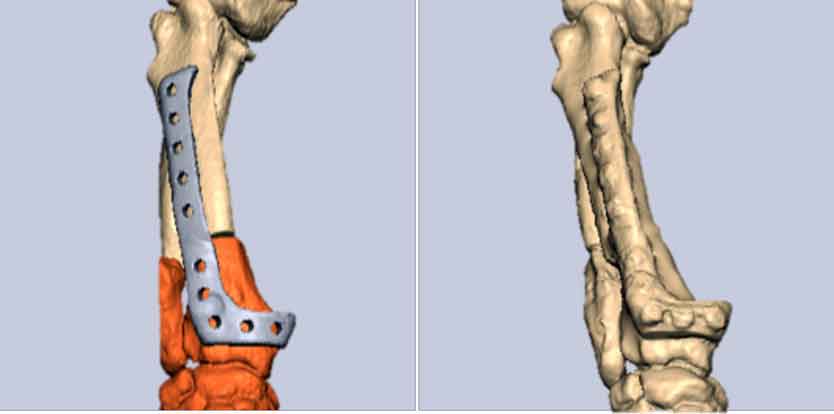 Preoperative – virtually planned implant position compared to postoperative – final implant position. The external straightened limb during the five-week postoperative review. Image: CBM Medical.