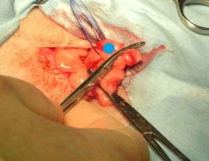 Figure 18. The pre-tied ligature loop is slid proximally over the ovary and temporarily “parked” over the ovarian pedicle. Blue circle shows the position of the ovary.