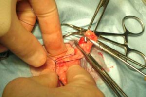 Figure 19. Allis forceps apply light traction on the ovary. Once these forceps are removed, a pair of artery forceps are applied over the ovarian pedicle at the point it will be cut, distal to the forceps.