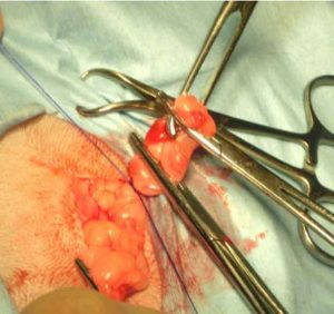 Figure 21. The ovarian pedicle is cut just distal to the lower artery forceps.