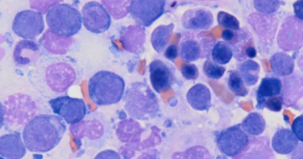 Rubriphagocytosis on cytology of a bone marrow core biopsy.