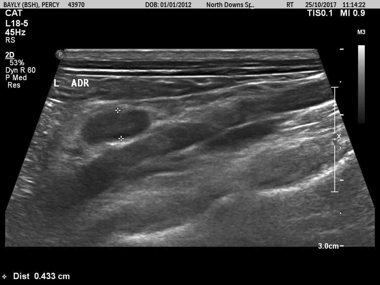 Figure 2a. Ultrasound scans of the left adrenal gland.