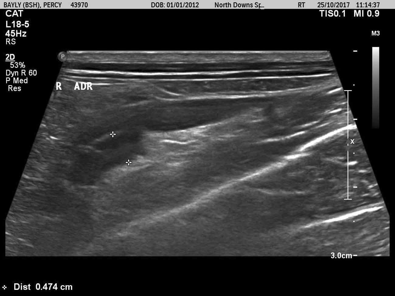 Figure 2b. Ultrasound scan of the right adrenal glands.