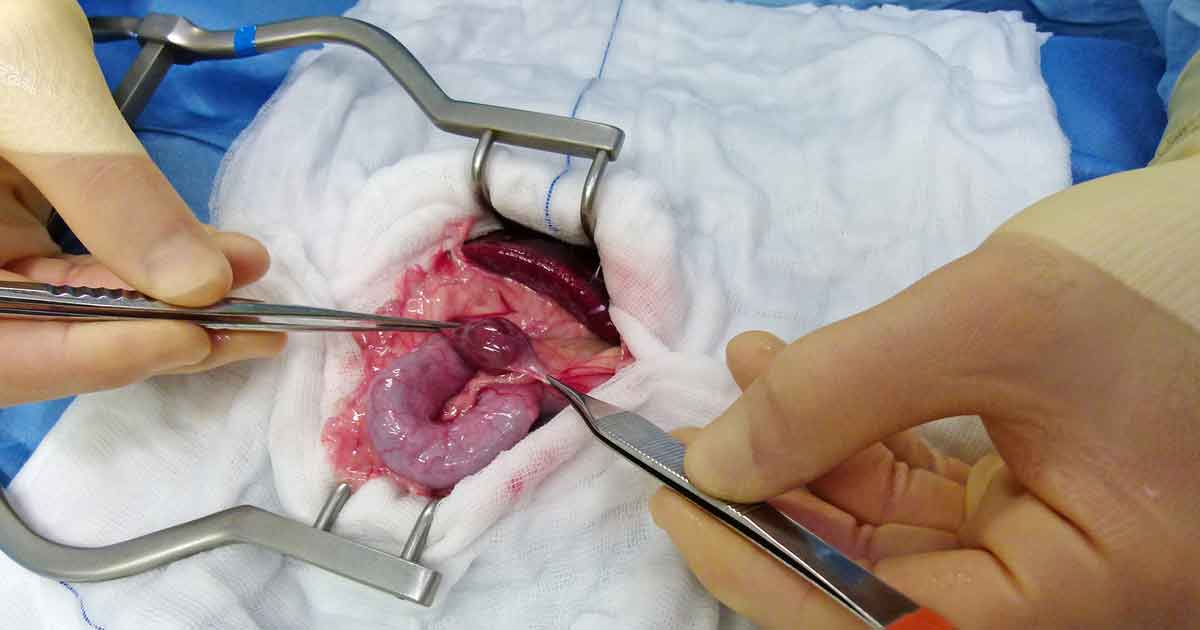 Figure 4. Resection of the intra-abdominal testicle. Image: Benito de la Puerta