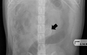 Figure 1b. A ventrodorsal abdominal radiograph. An oval, mineralised opacity is present just left of the midline in the caudal abdomen.