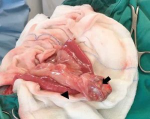 Figure 2. A well-demarcated, ovoid, 5cm × 2.5cm × 2cm cystic mass is present in the mesentery, adjacent to the mid-jejunum.
