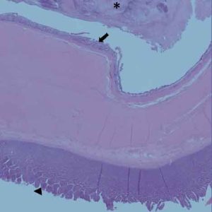 Figure 3. Photomicrograph representing the normal villous mucosa of the jejunum (arrowhead), the colonic-type mucosal lining of the adjacent persistent vitelline duct cyst (arrow) and the cyst contents (asterisk).